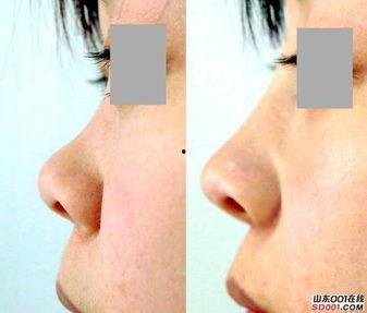 鼻假体照片
